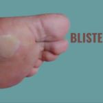 blisterata